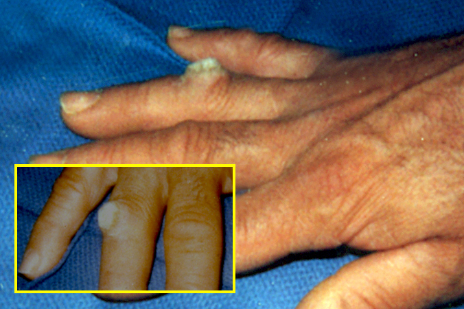 wart-verruca-vulgaris-hand-surgery-resource